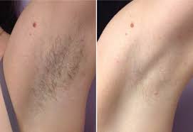 underarm laser hair removal