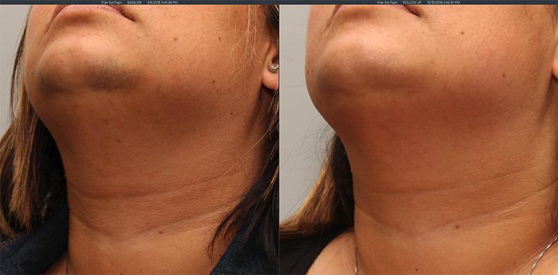 laser hair removal chin