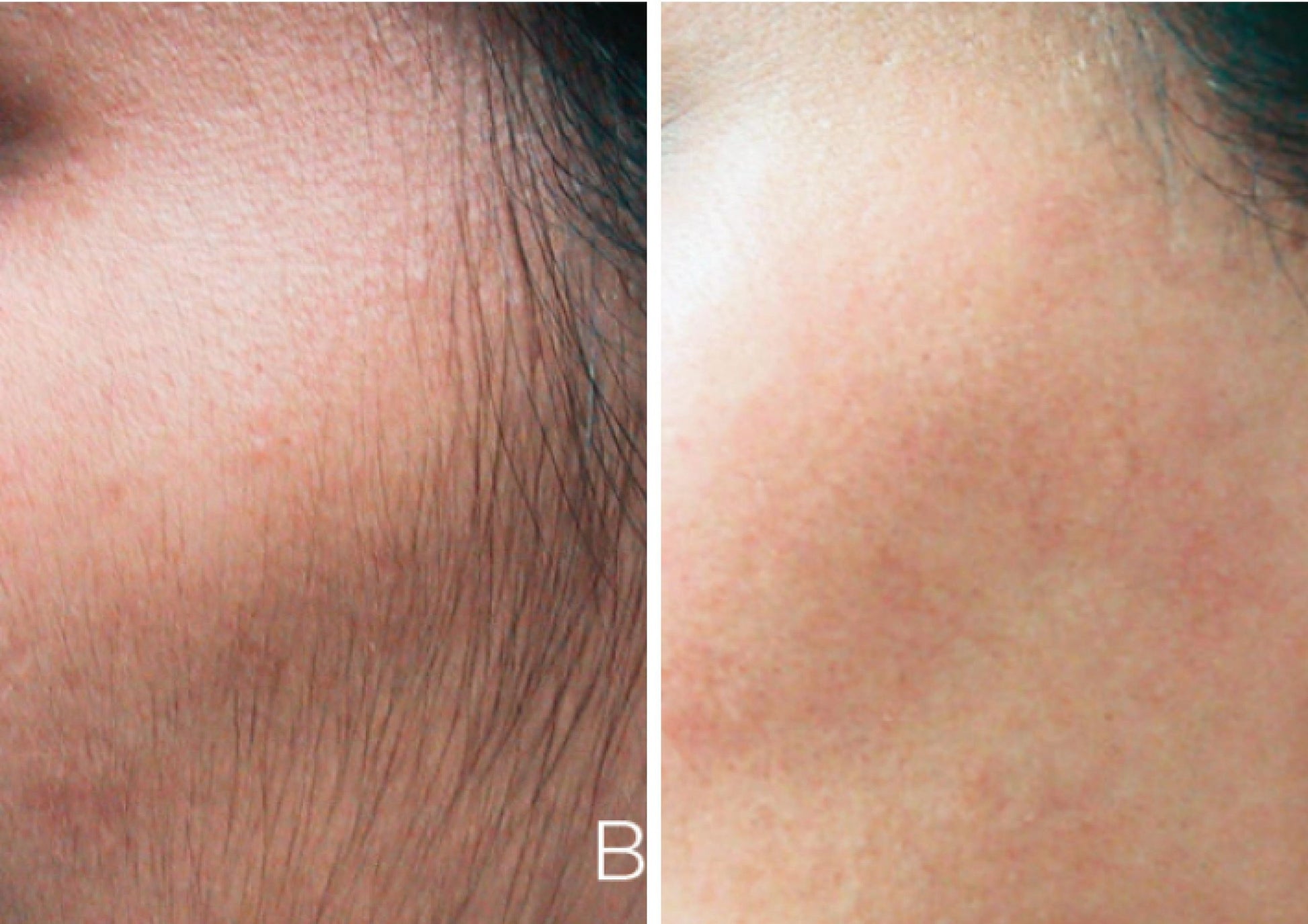 IPL Laser Before and After