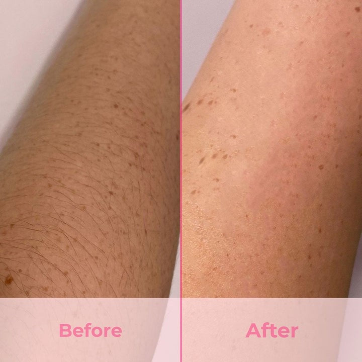 IPL Laser Before and After